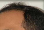 Hair Restoration by NeoGraft®