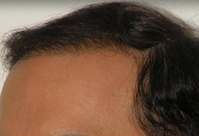 Hair Restoration by NeoGraft® before and after photo