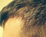 Hair Restoration by NeoGraft® Before and after photo