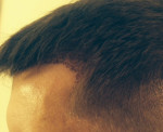 Hair Restoration by NeoGraft®