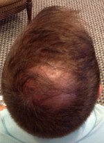 Hair Restoration by NeoGraft® Before and after photo