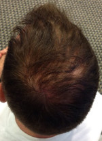 Hair Restoration by NeoGraft® Before and after photo