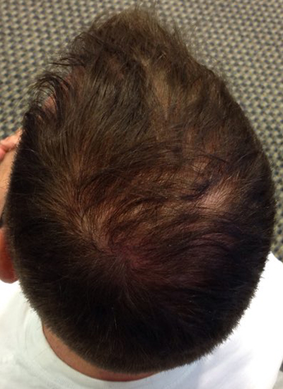 Hair Restoration by NeoGraft® before and after photo