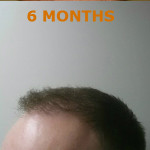 Hair Restoration by NeoGraft® Before and after photo