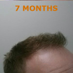 Hair Restoration by NeoGraft® Before and after photo