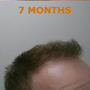 Hair Restoration by NeoGraft® before and after photo