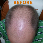 Hair Restoration by NeoGraft® Before and after photo