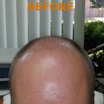 Hair Restoration by NeoGraft®