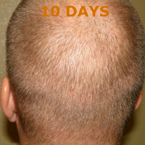 Hair Restoration by NeoGraft® before and after photo