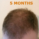 Hair Restoration by NeoGraft® Before and after photo