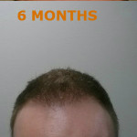 Hair Restoration by NeoGraft® Before and after photo