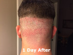 Hair Restoration by NeoGraft® Before and after photo