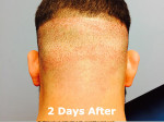 Hair Restoration by NeoGraft® Before and after photo