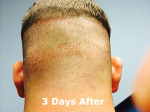 Hair Restoration by NeoGraft®