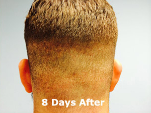 Hair Restoration by NeoGraft® before and after photo