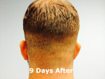 Hair Restoration by NeoGraft® Before and after photo