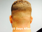 Hair Restoration by NeoGraft® Before and after photo