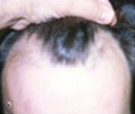 Hair Restoration by NeoGraft® Before and after photo