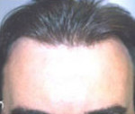 Hair Restoration by NeoGraft® Before and after photo