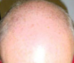 Hair Restoration by NeoGraft® Before and after photo