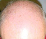 Hair Restoration by NeoGraft® before and after photo