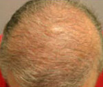 Hair Restoration by NeoGraft® Before and after photo