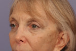 Eyelid Surgery Before and after photo