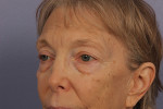 Eyelid Surgery Before and after photo