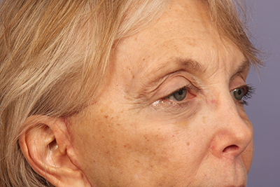 Eyelid Surgery before and after photo