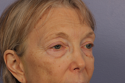 Eyelid Surgery before and after photo