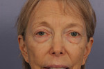 Eyelid Surgery Before and after photo