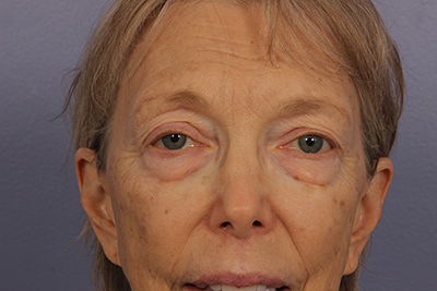 Eyelid Surgery before and after photo