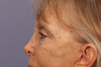 Eyelid Surgery before and after photo