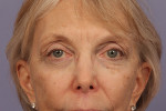 Eyelid Surgery Before and after photo