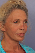 Facelift Before and after photo