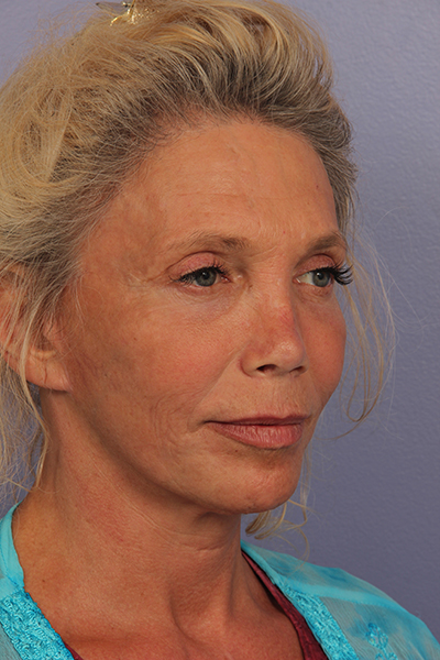 Facelift before and after photo