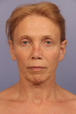 Facelift Before and after photo