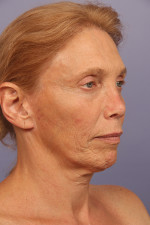 Facelift Before and after photo