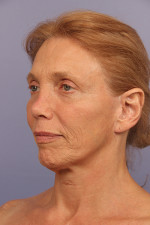 Facelift Before and after photo