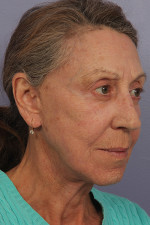 Facelift Before and after photo