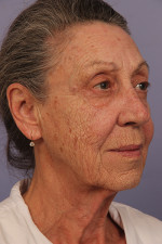 Facelift Before and after photo