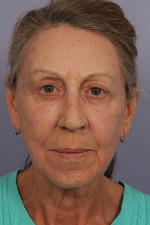 Facelift Before and after photo