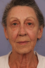 Facelift Before and after photo