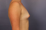 Breast Augmentation Before and after photo