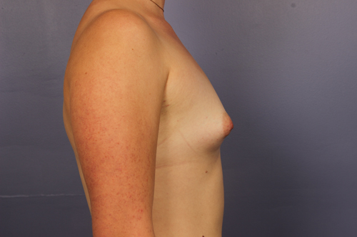 Breast Augmentation before and after photo