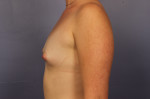 Breast Augmentation Before and after photo