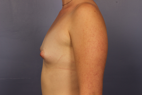 Breast Augmentation before and after photo