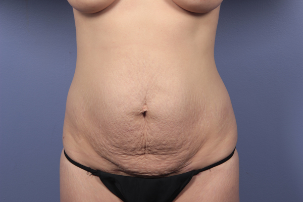Tummy Tuck before and after photo