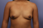 Breast Augmentation Before and after photo