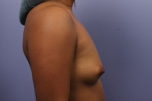 Breast Augmentation before and after photo